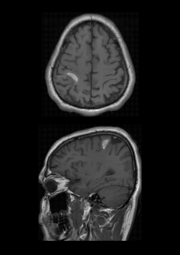 Cerebral Venous Thrombosis