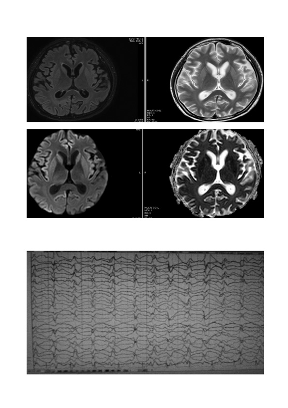 Abnormal Behavioral and Cognitive Impairment