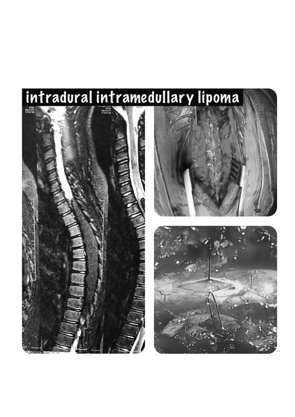 รายงานผู้ป่วย Spinal Intramedullary Lipoma