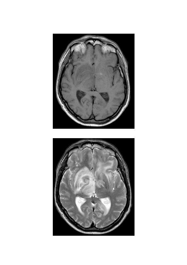 Cerebral Toxoplasmosis