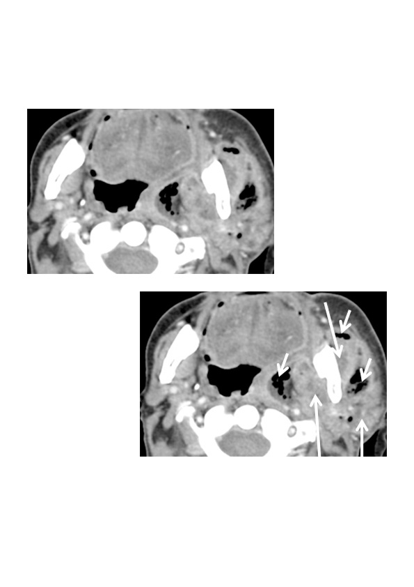 Masticator Space Abscess