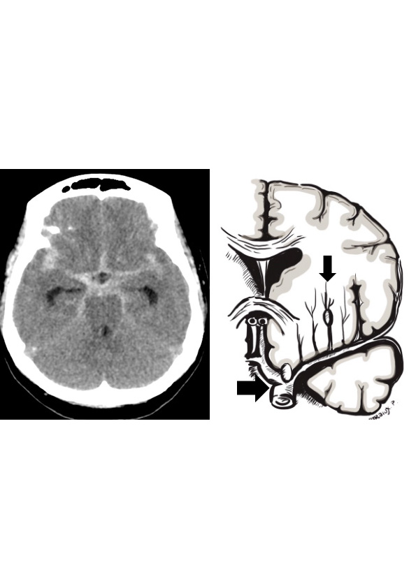 แนวทางการดูแลผู้ป่วย Hemorrhagic Stroke เขตสุขภาพที่ 7